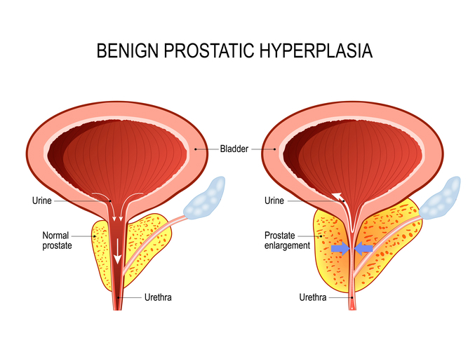 Agrandamiento de la próstata (HPB)