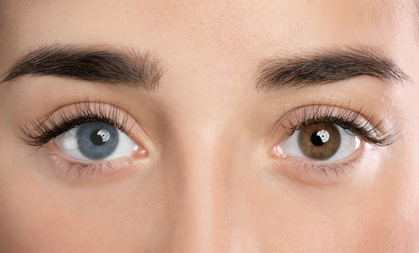 Conditions affecting one's eye color