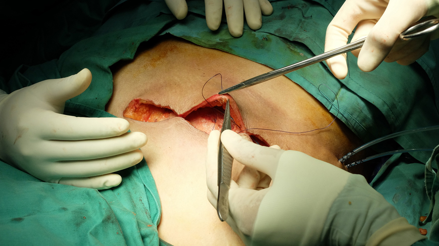 escisión quirúrgica de la mama