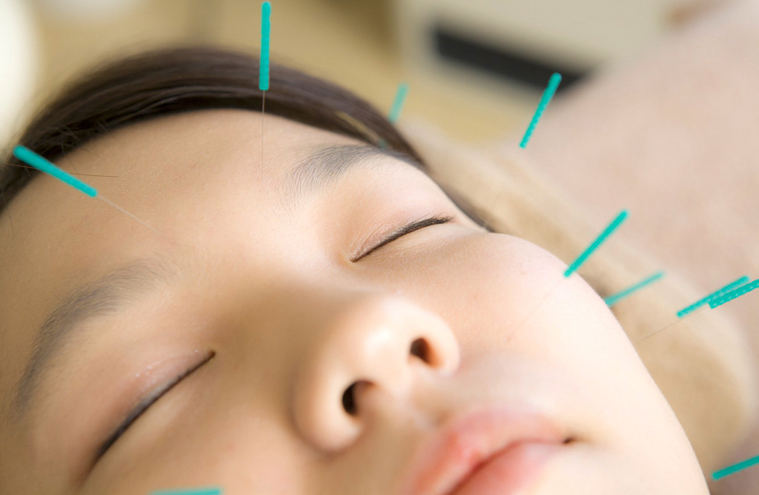 Bell’s palsy and acupuncture