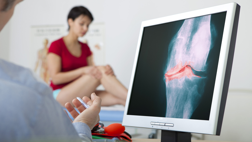 Knee Osteoarthritis Diagnosis