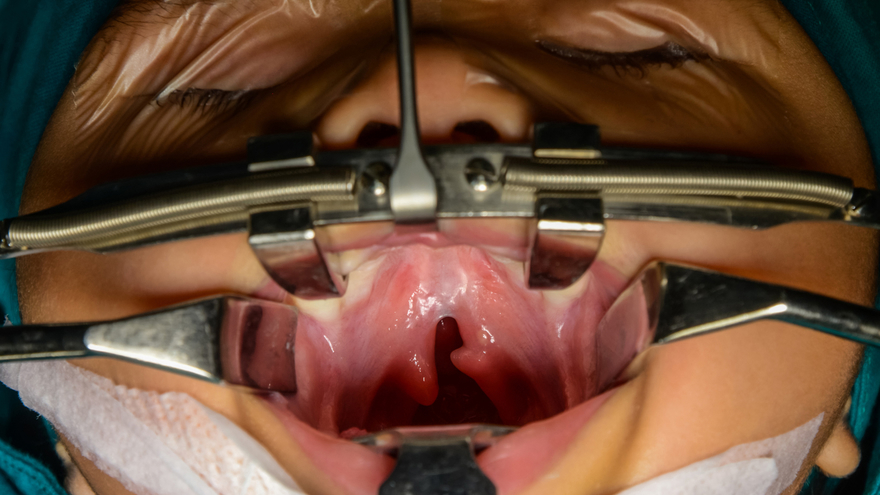 Cleft palate Management