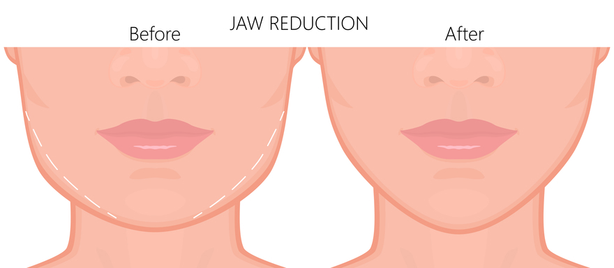 After Jaw Reduction Surgery