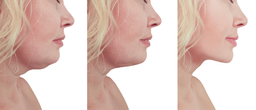 Facial Liposuction Recovery