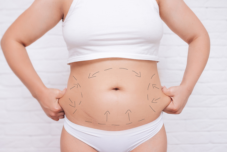 abdominal liposuction