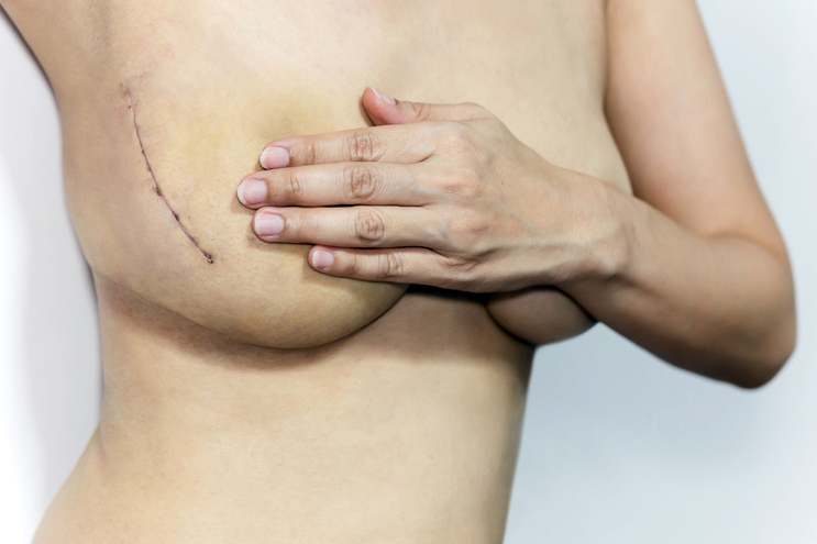 Complicaciones de la mastectomía