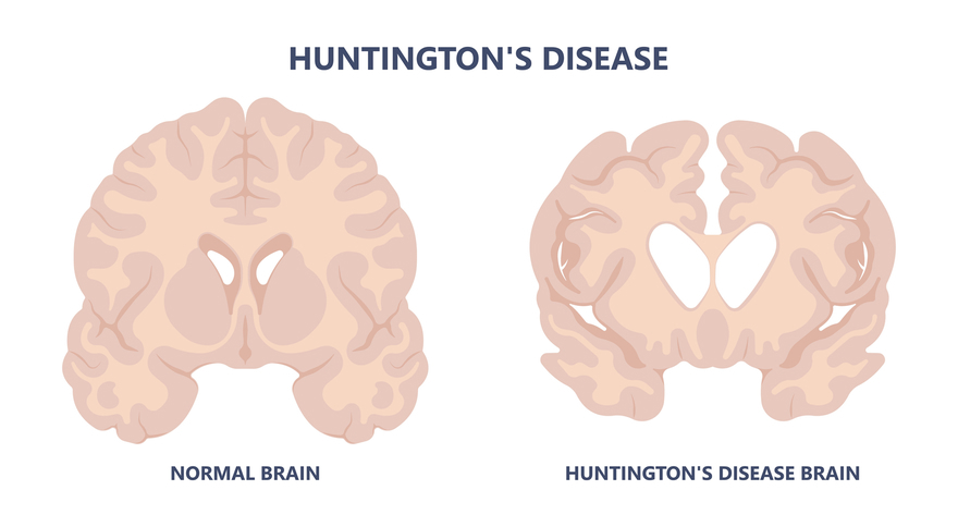Huntington disease Causes
