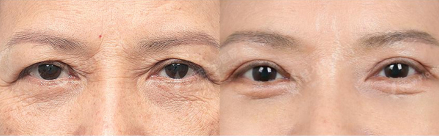 Before and After ptosis correction