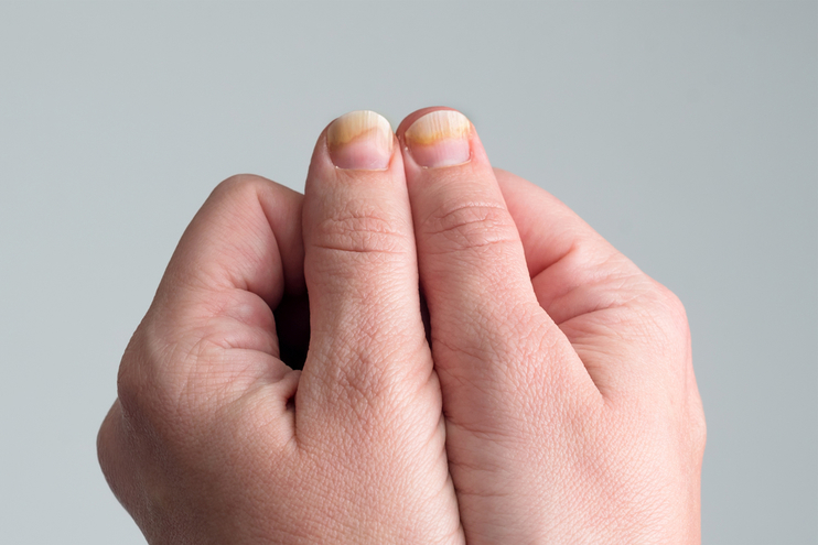 Evaluation of Nail Abnormalities | AAFP