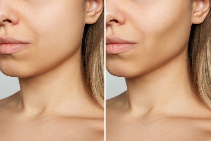 During Front Cheekbone Surgery