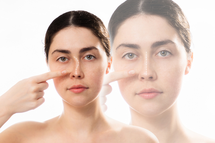 Introduction: What You Need to Know About Revision Rhinoplasty