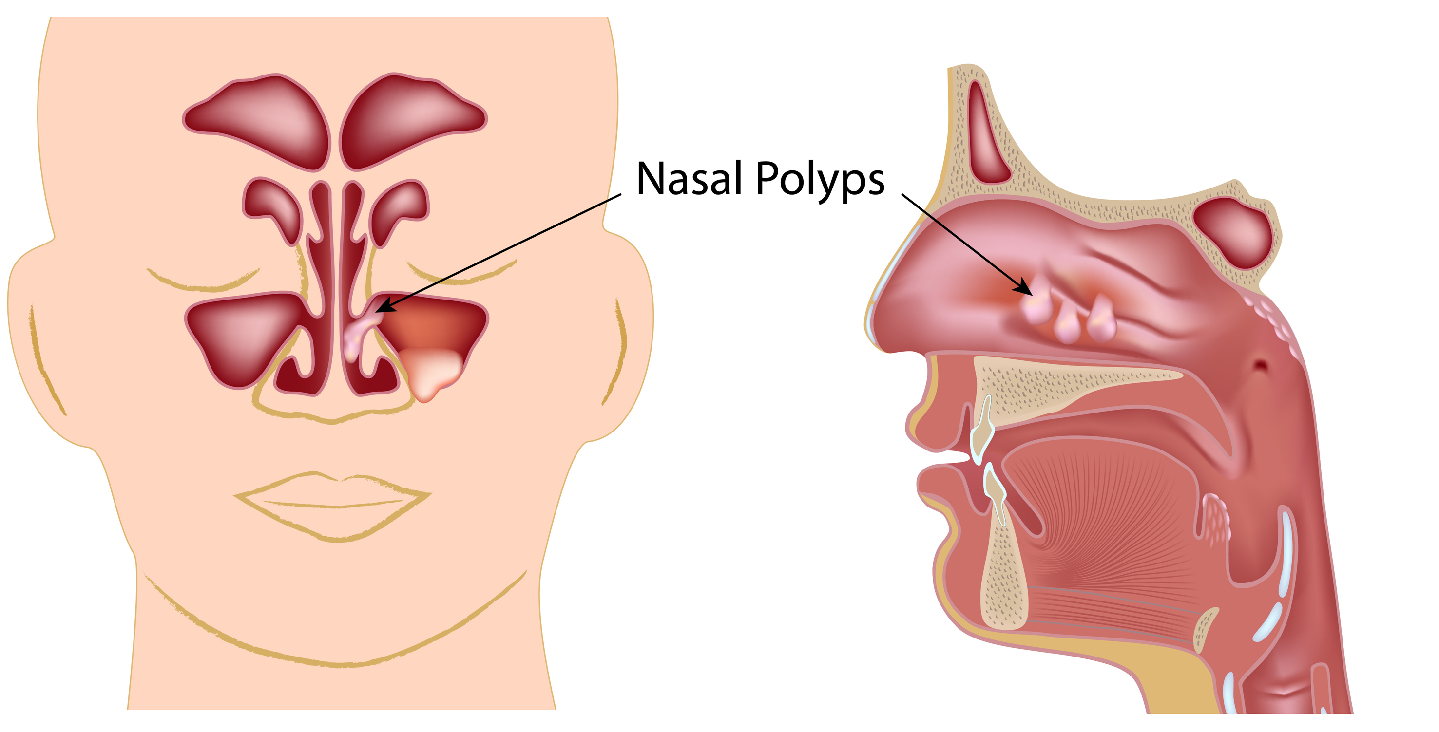 Nasal Polyp Treatment