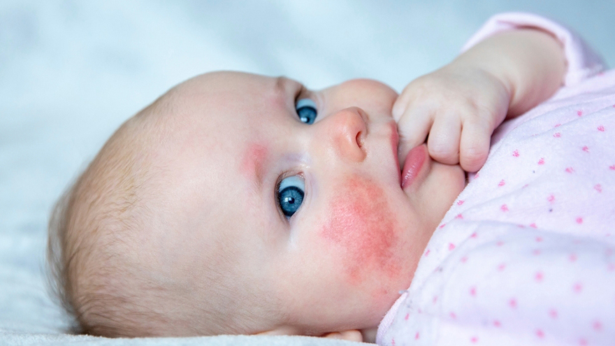Skin Rashes in Children