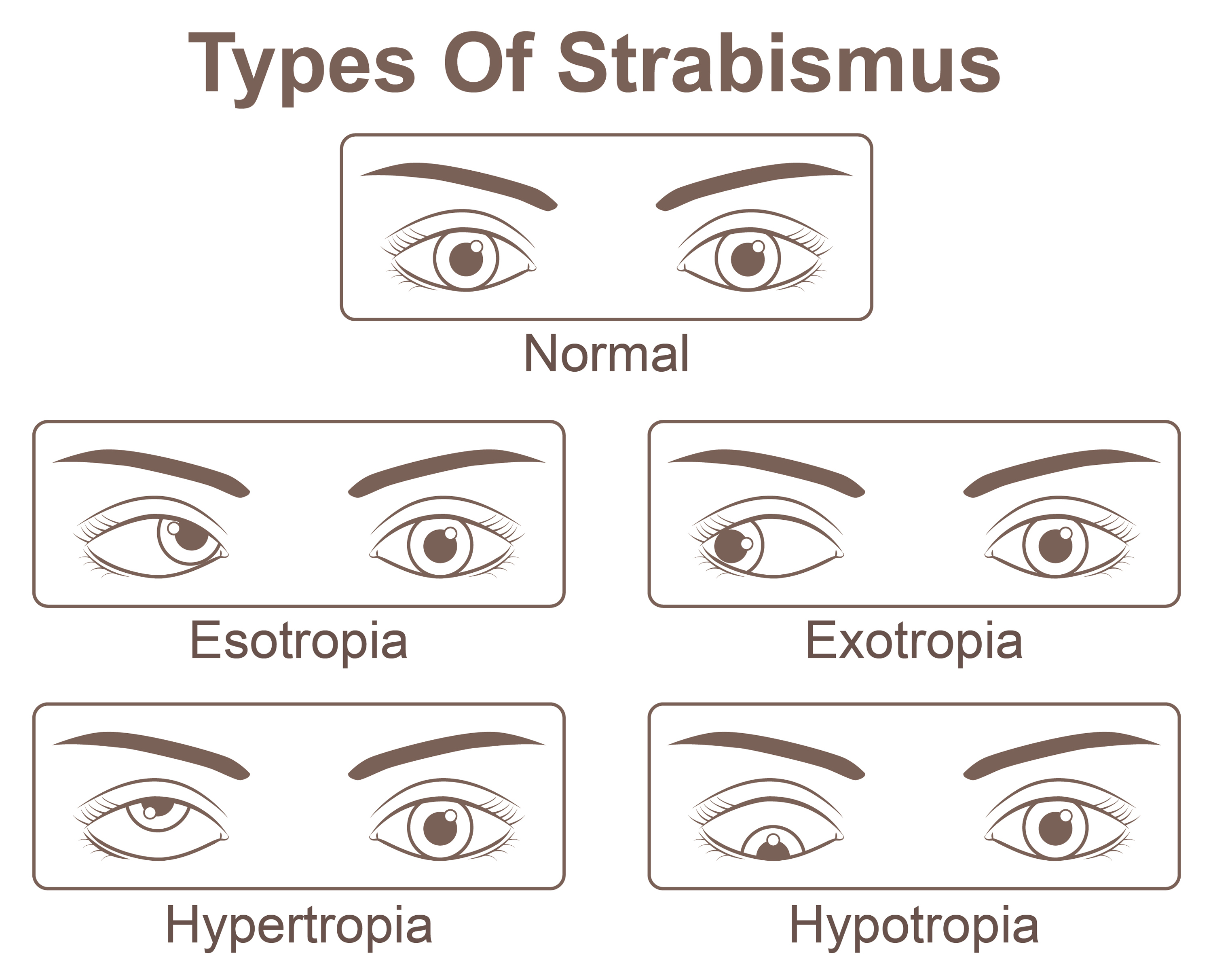 https://chblob.icloudhospital.com/images/1-Strabismus-7334dd8a-0d77-45dd-9b83-fc409ec11def.jpg