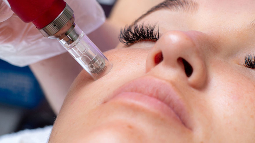 Facial microneedling