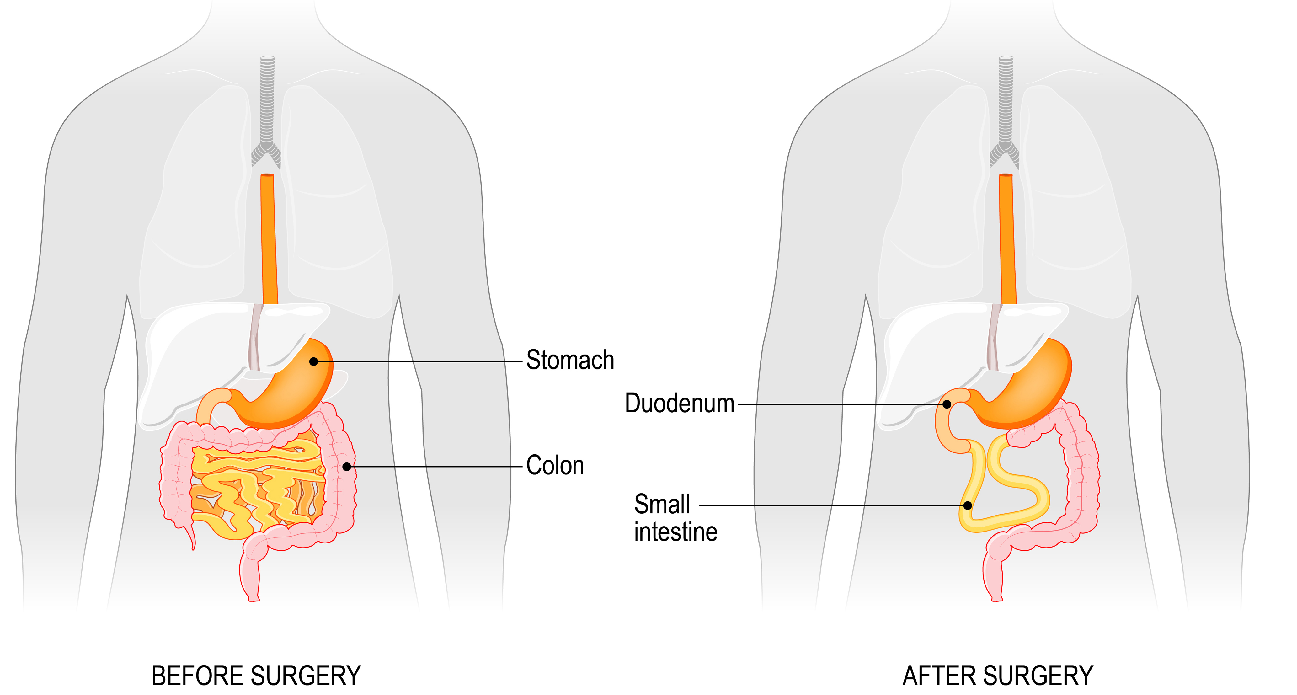 Short Bowel Syndrome Care