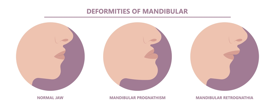 O que causou a deformação na mandíbula dos Habsburgos?