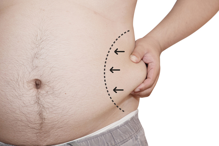 Liposuction for Men