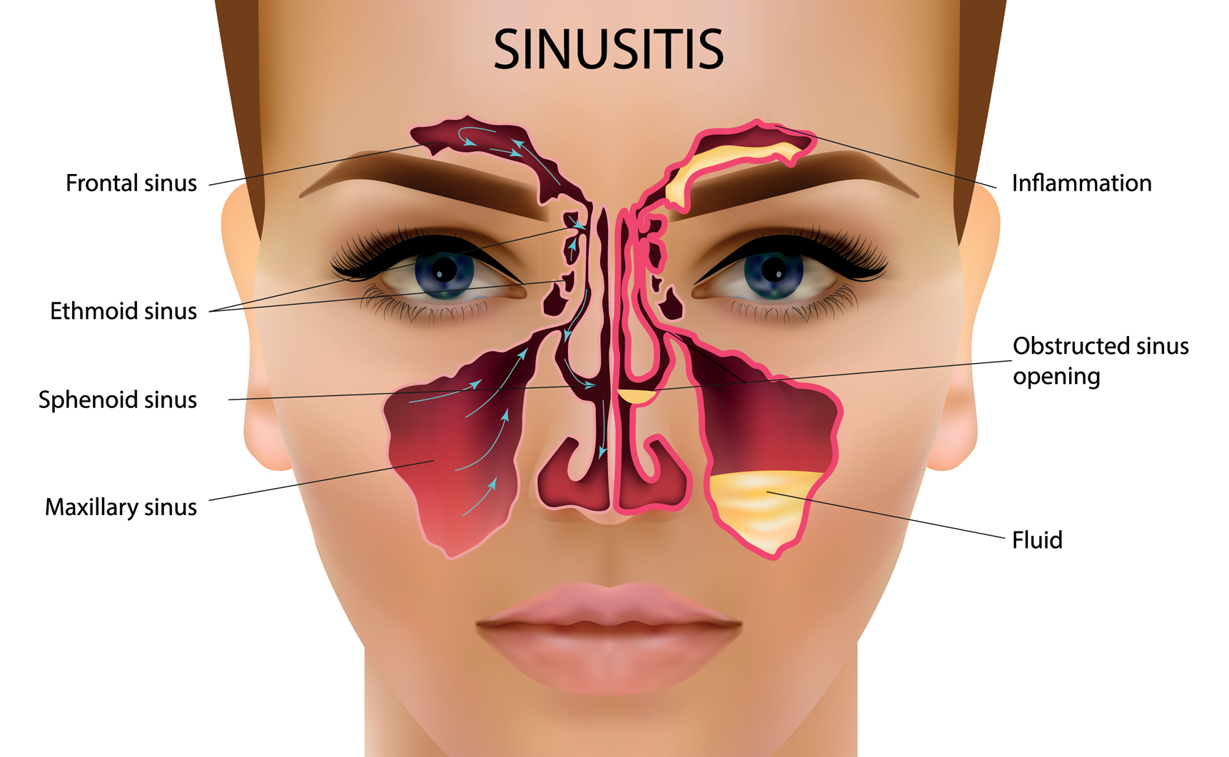La sinusite peut causer un syndrome de choc toxique