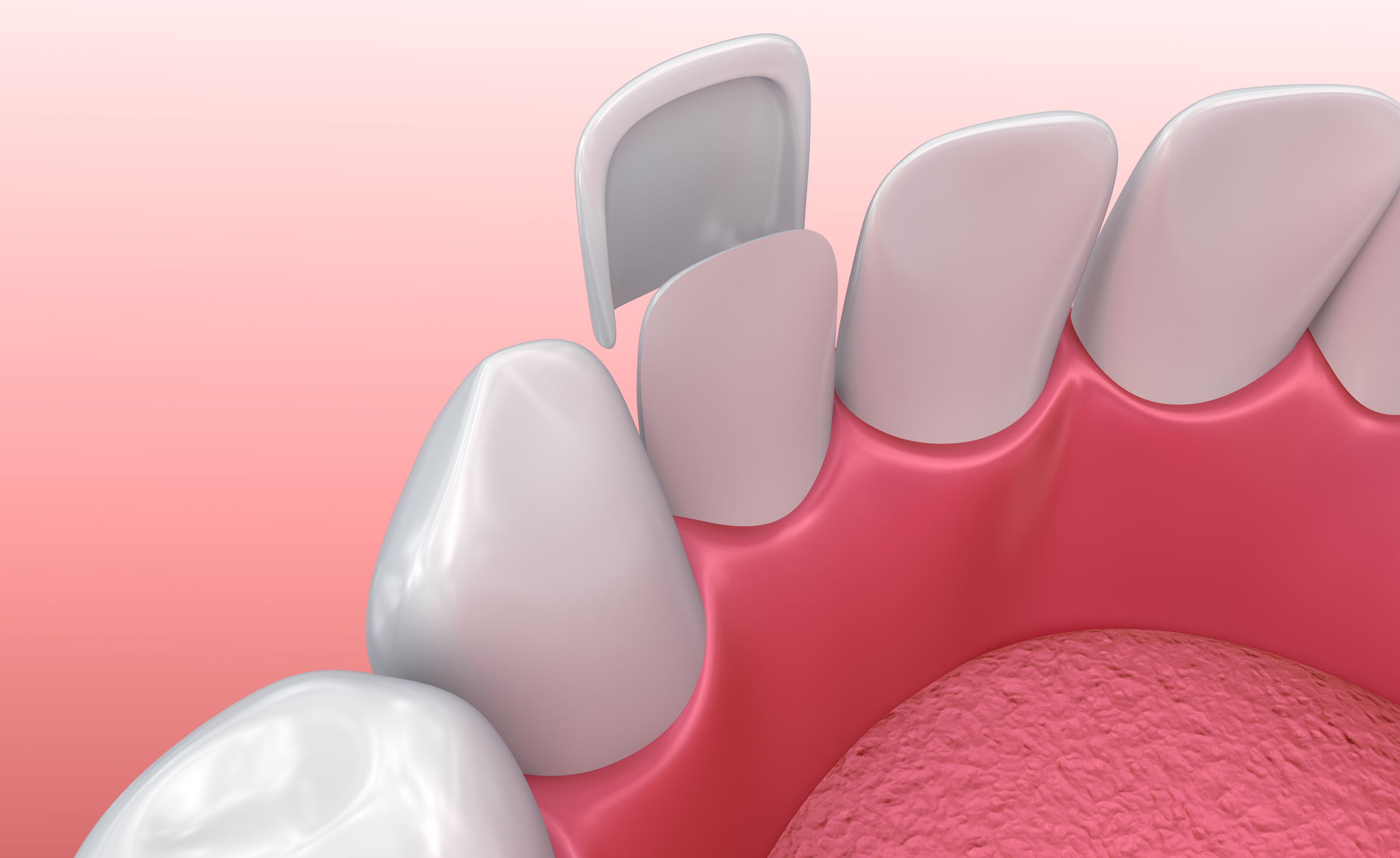 Juego de 2 carillas dentales a presión para blanquear la dentadura