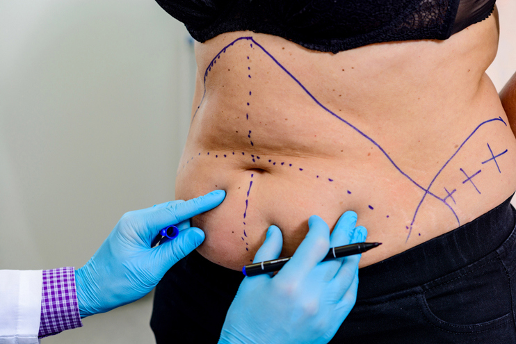 Abdominal Contouring Surgery