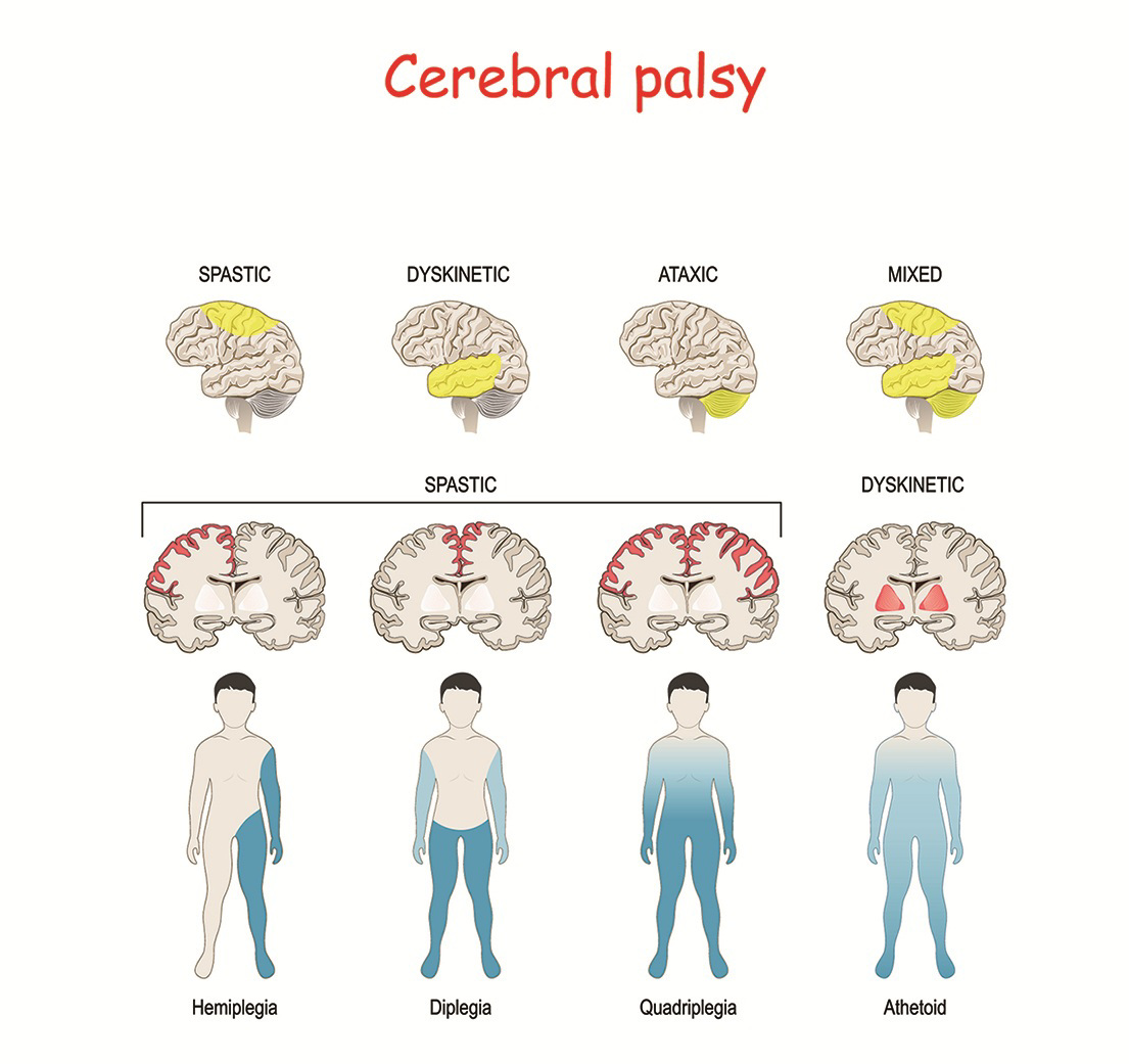 parálisis cerebral mixta