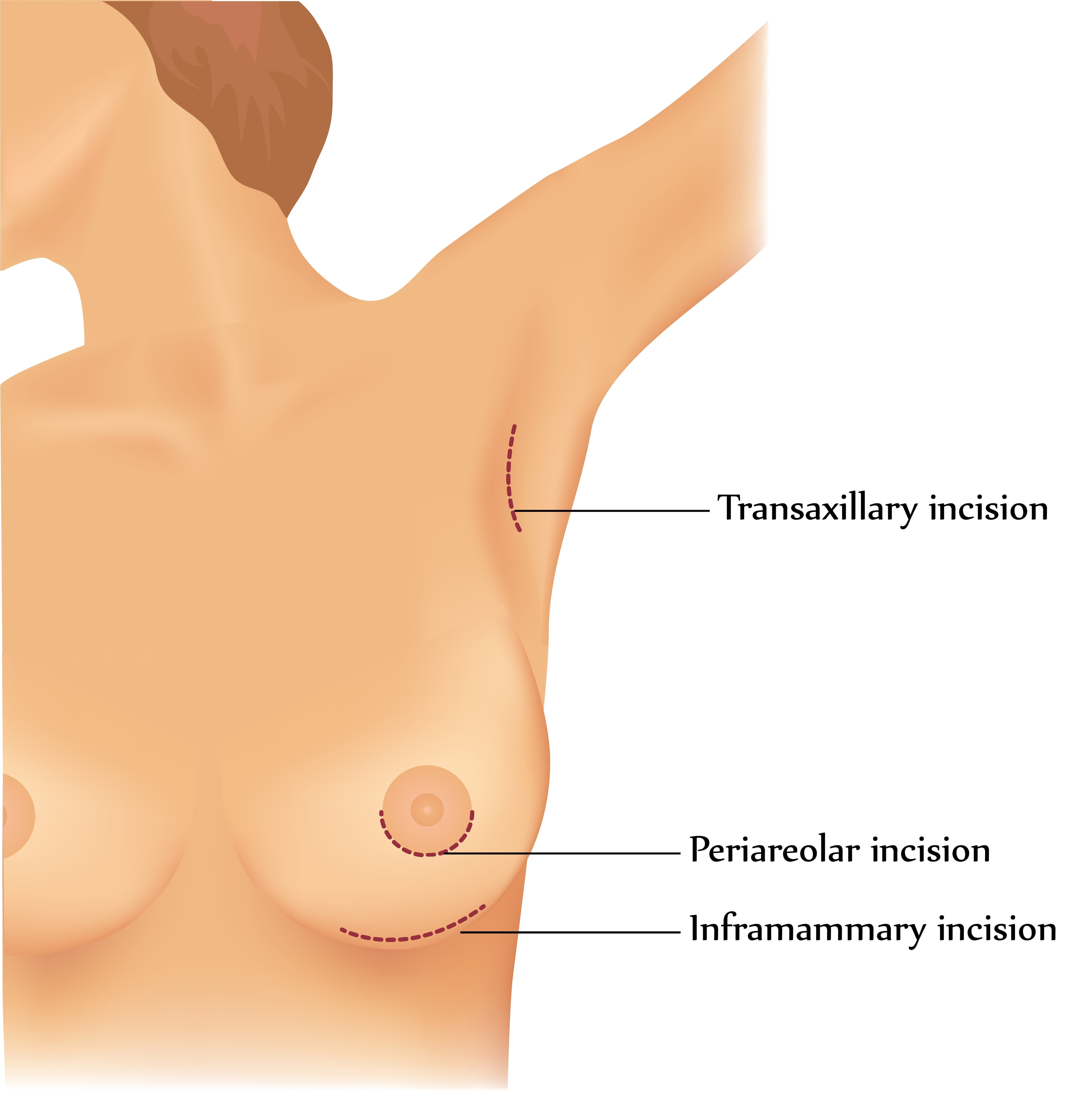 Breast Augmentation Sub muscular IMF Incision 