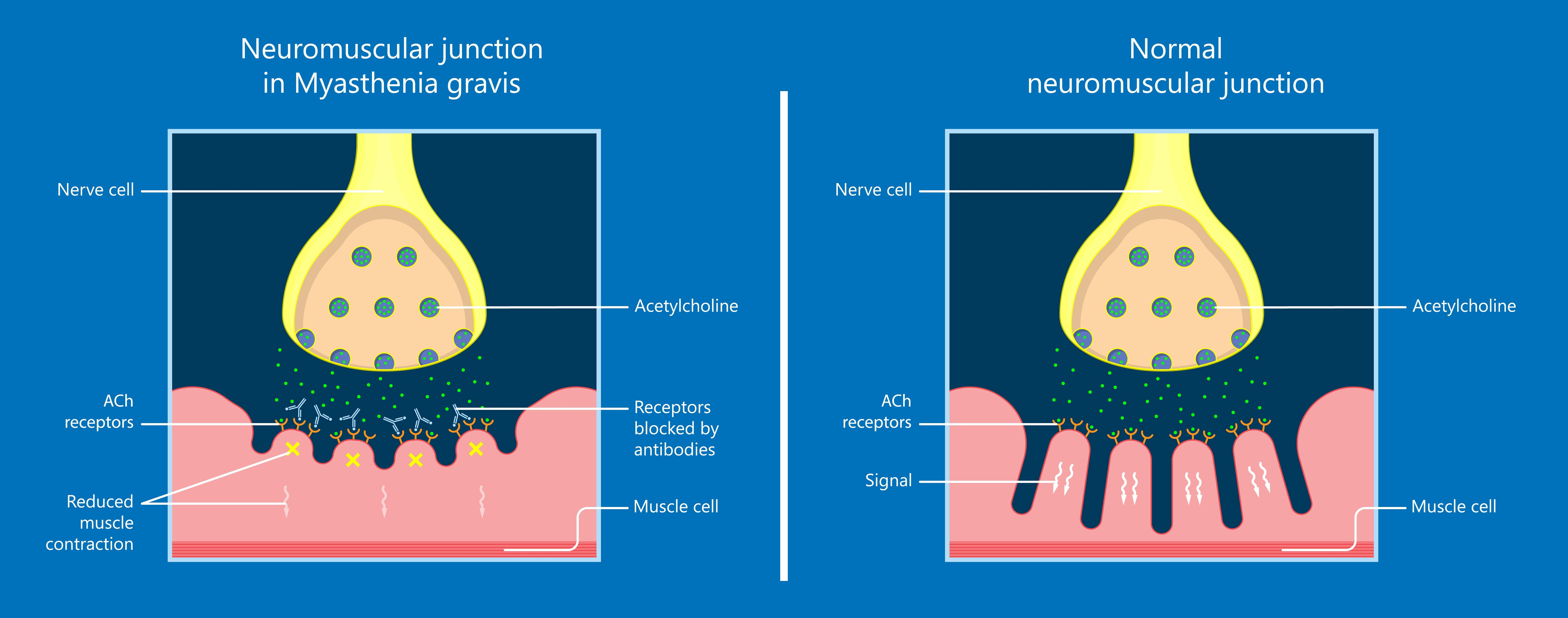 重症肌无力（MG）管理
