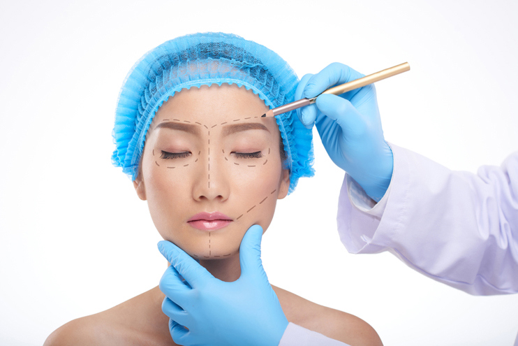 Facelift procedure
