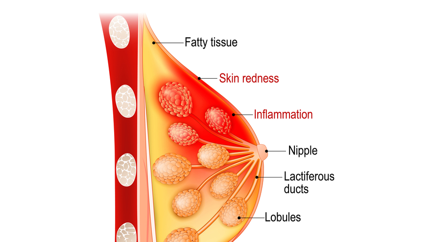 Benign Breast Disease