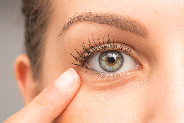 Lower Eyelid Bags