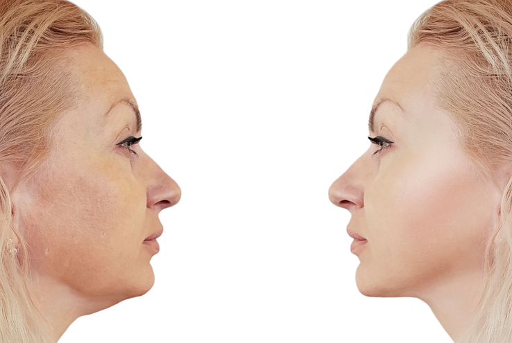 Double Chin Reduction
