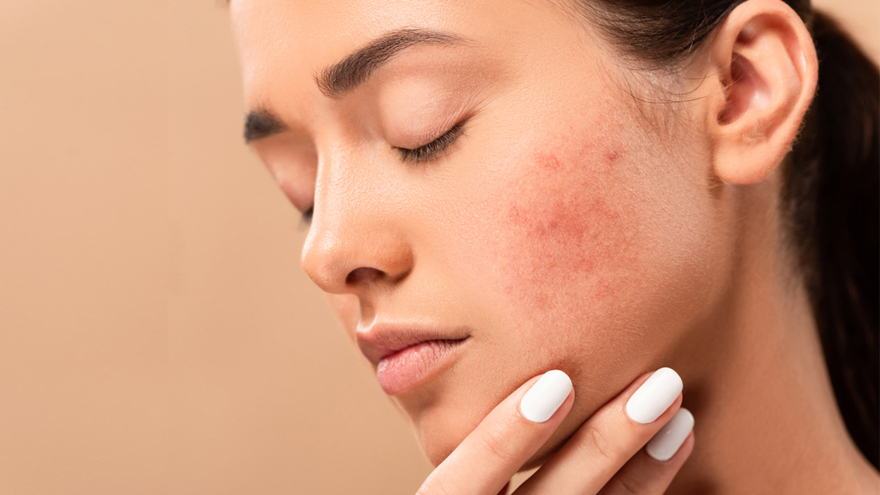 Acne Scars
