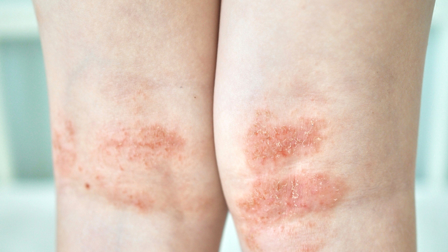 Atopic Dermatitis