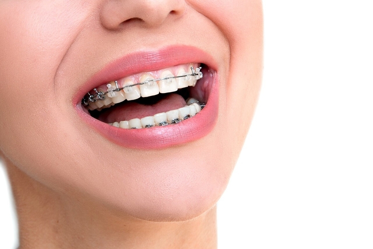 Clippy-C Braces
