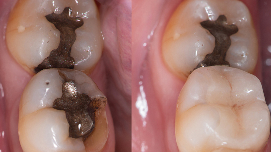 Fillings