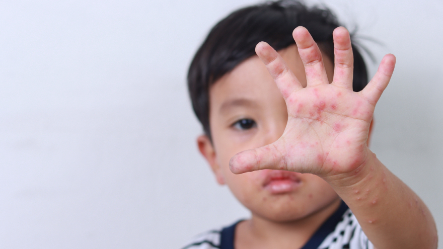 Hand, Foot, and Mouth Disease