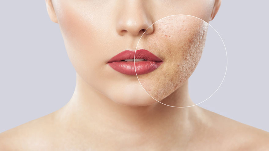 Inflammatory Acne