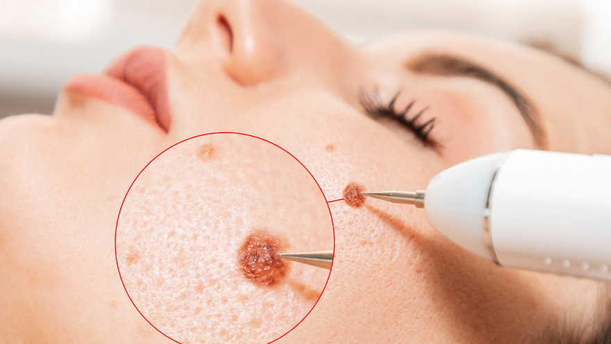 Warts are caused by HPV and can spread through direct contact