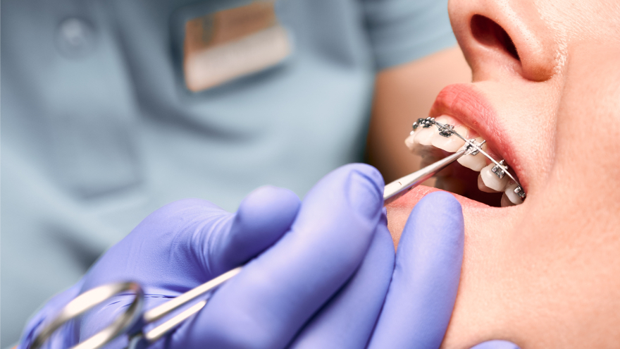 Dental Braces Treatment in Dentistry for Misaligned Teeth and Bite Problems