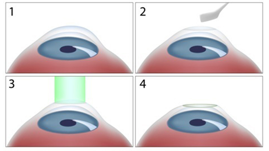 SMILE LASIK