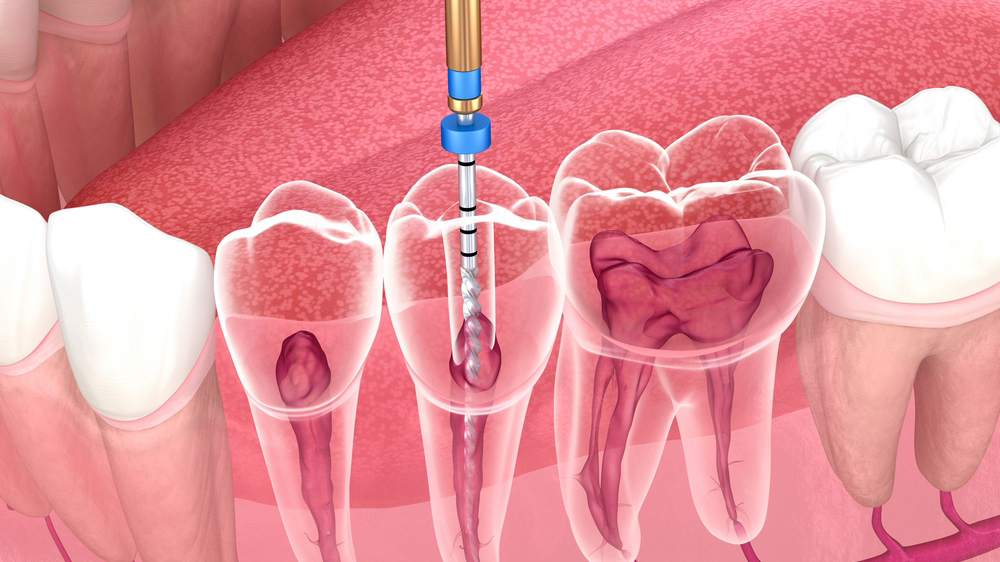 Pemulihan Setelah Perawatan Saluran Akar