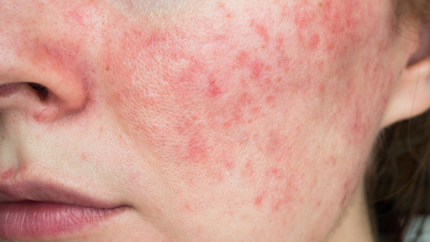Pores have enlarged post-acne