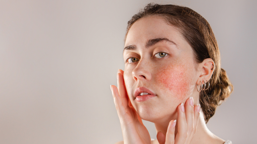 Rosacea