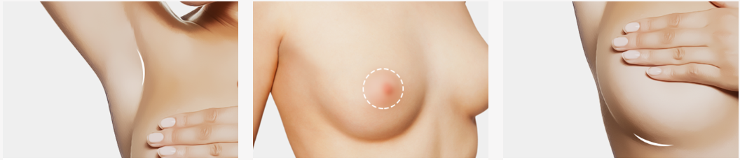 Diagram demonstrating surgical marking and measurement points for breast lift evaluation.