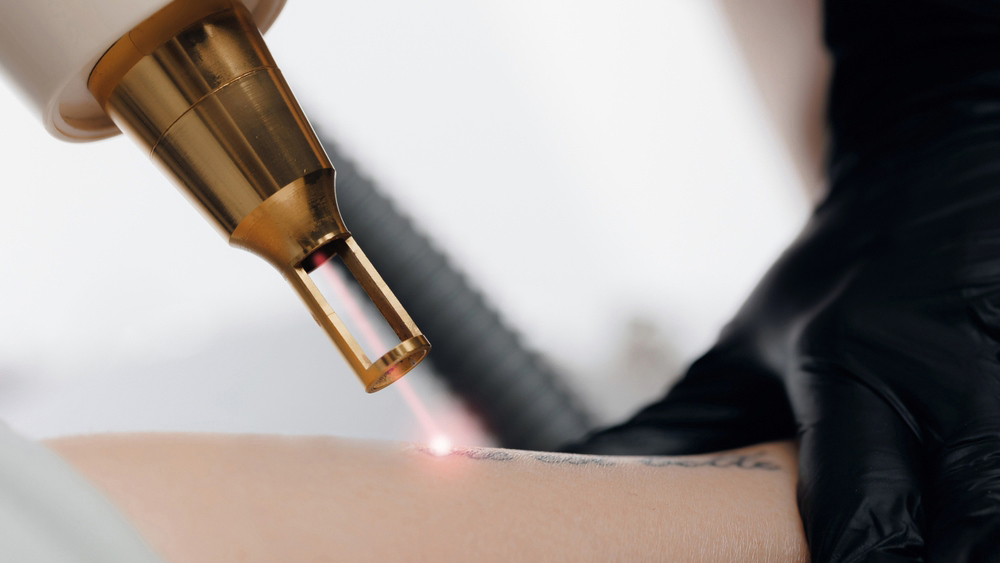 การลบลายสัก