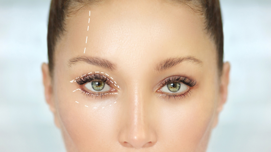 Upper Eyelid Surgery