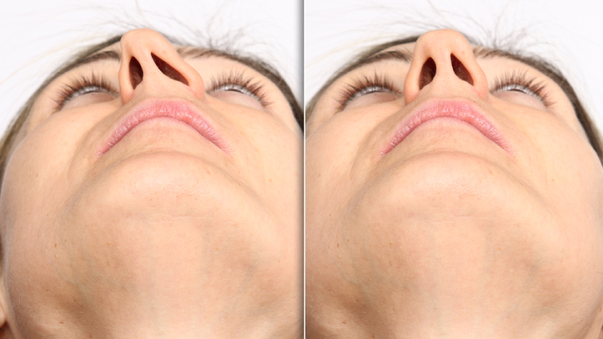 deviated septum