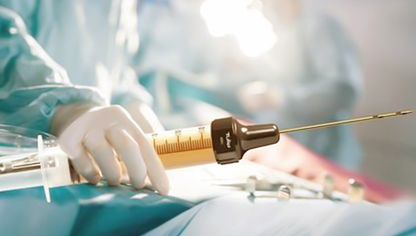 Surgeon holding a syringe filled with purified fat for facial fat grafting and transfer procedure.