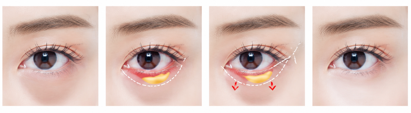 Four-panel illustration of the under-eye area showing protruding fat, the inner-eyelid approach, fat removal and grafting, and the under-eye contour after the procedure